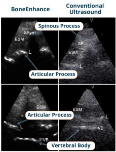 Accuro versus conventional ultrasound image