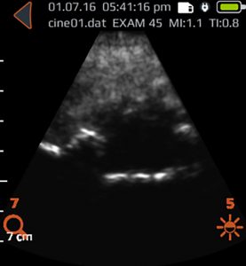 Accuro BoneEnhance image showing interlaminar space