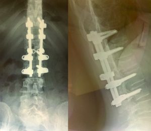 X-ray of patient's back
