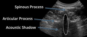 Transverse crosssectional conventional ultrasound image of a spinous process with articular process landmarks in view