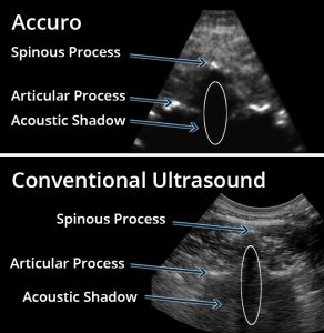 Accuro Versus Conventional Ultrasound