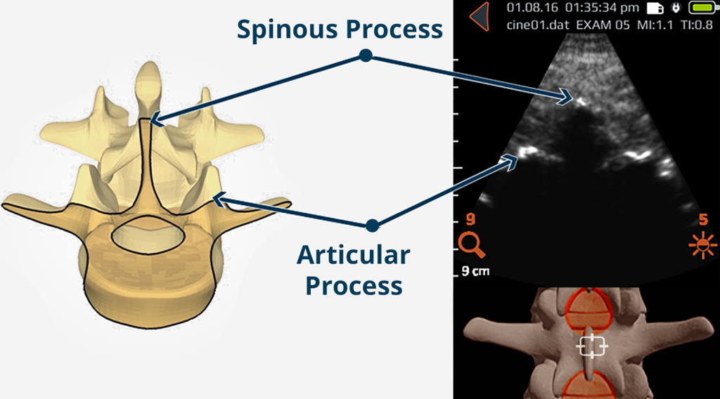 spinous process