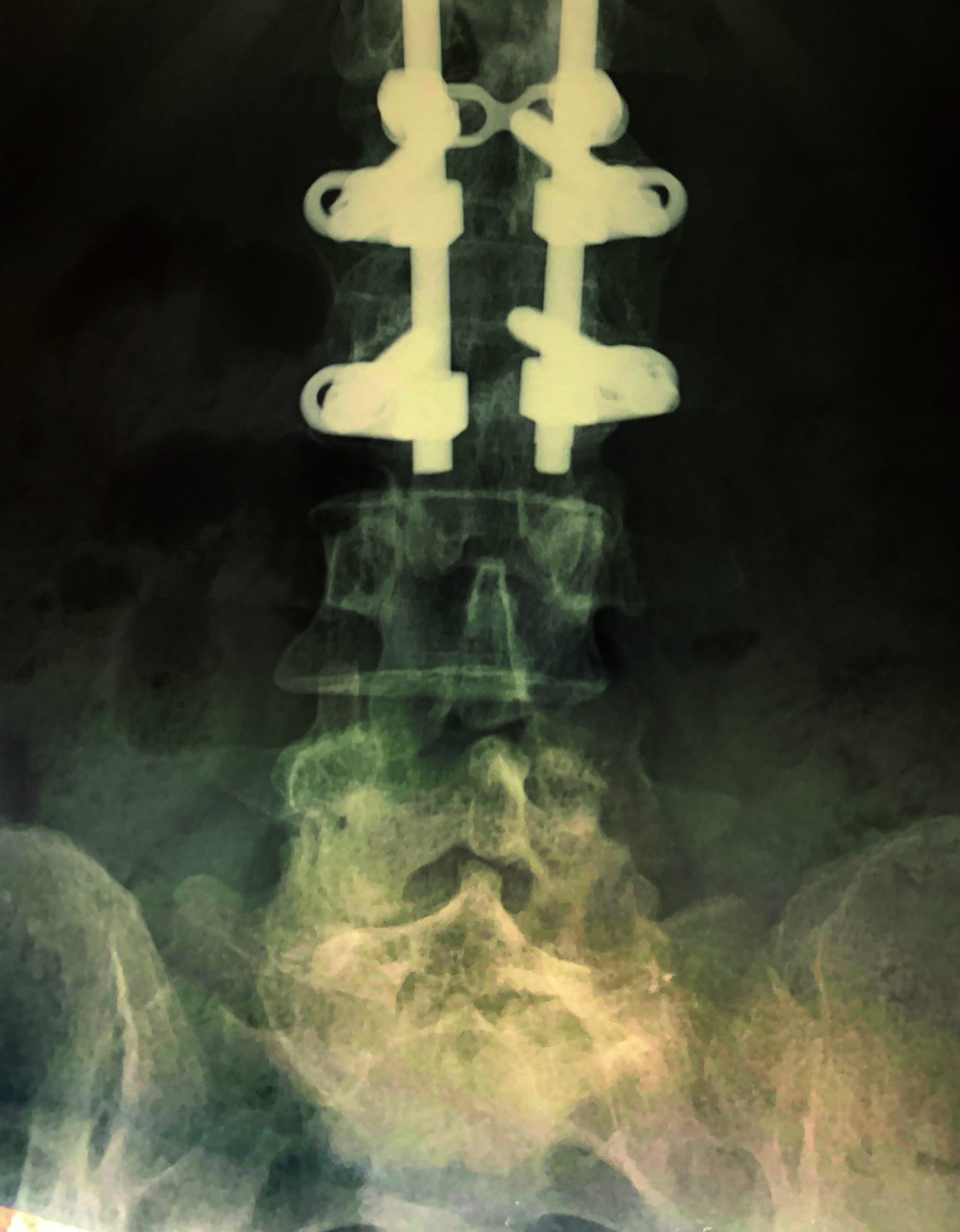 x-ray-reveals-narrowed-intervertebral-spaces Postoperative X-ray imaging