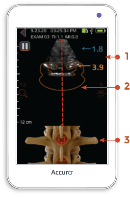 Accuro automated overlay — lumbar preset
