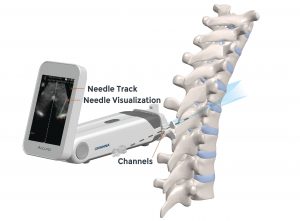 Accuro second generation scanning the spine with needle track needle visualization