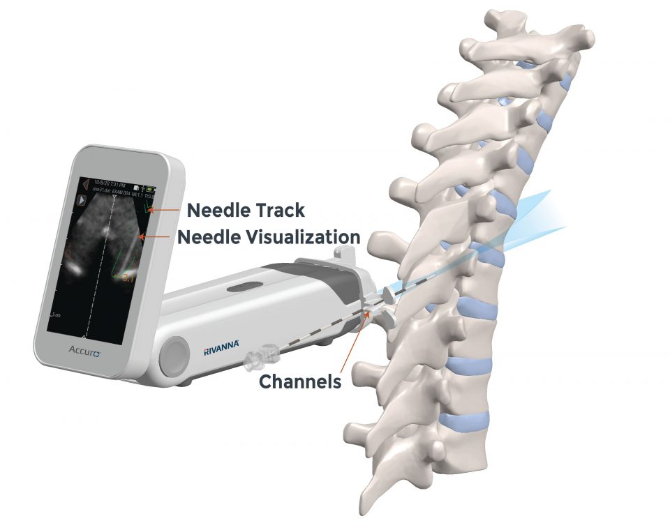 Accuro second generation scanning the spine with needle track needle visualization