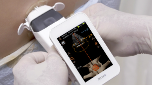 Accuro identifying the midline and epidural space