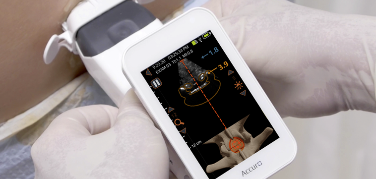Accuro identifying the midline and epidural space