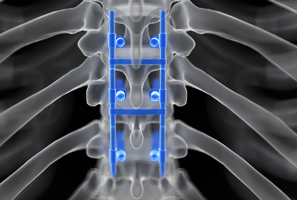 Neuraxial Anesthesia After Spine Surgery