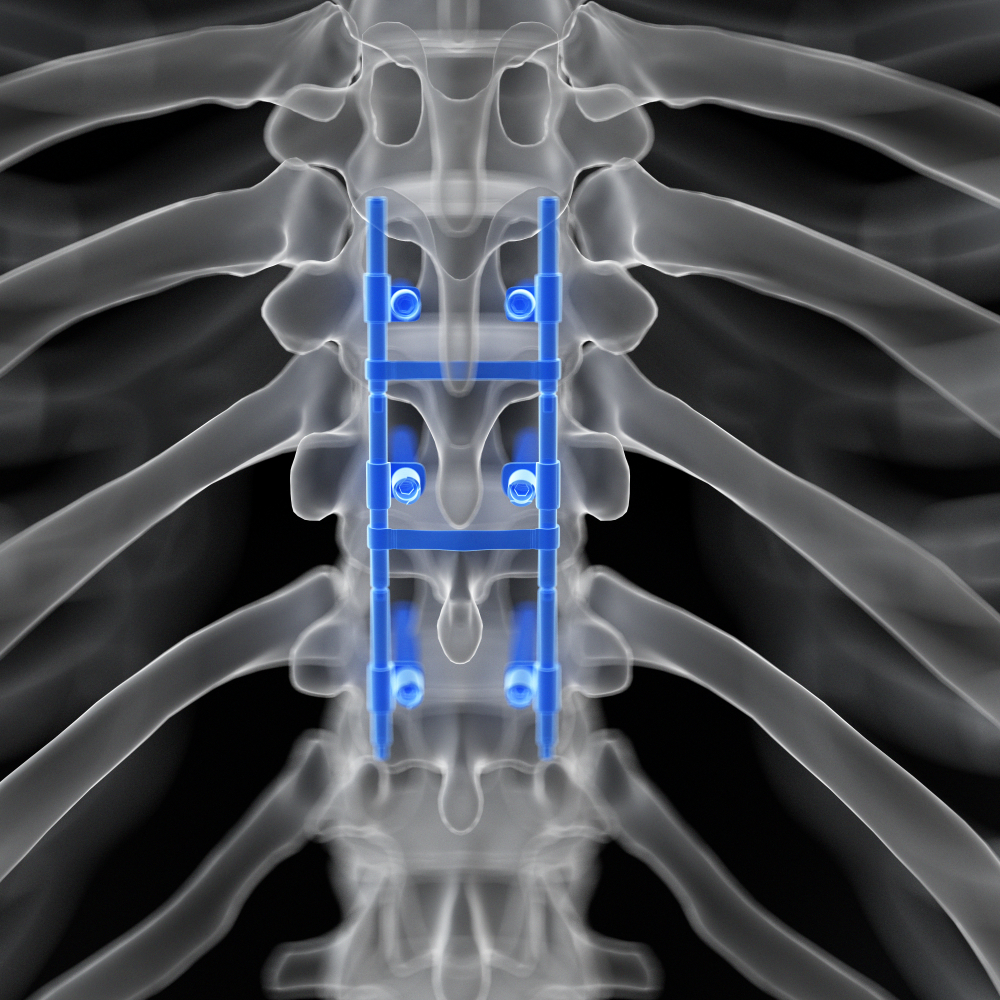 Neuraxial Anesthesia After Spine Surgery