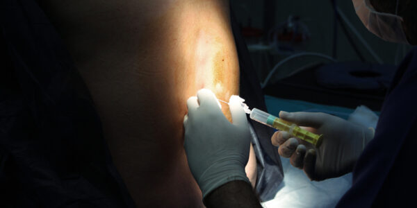 Epidural Placement