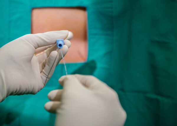 Epidural Analgesia epidural Nerve Block.