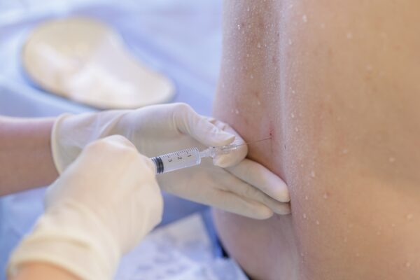 Close view of a needle delivering neuraxial anesthesia