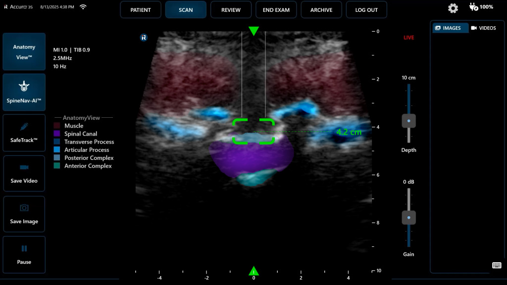 SpineNav-AI and AnatomyView live ultrasound guidance interface
